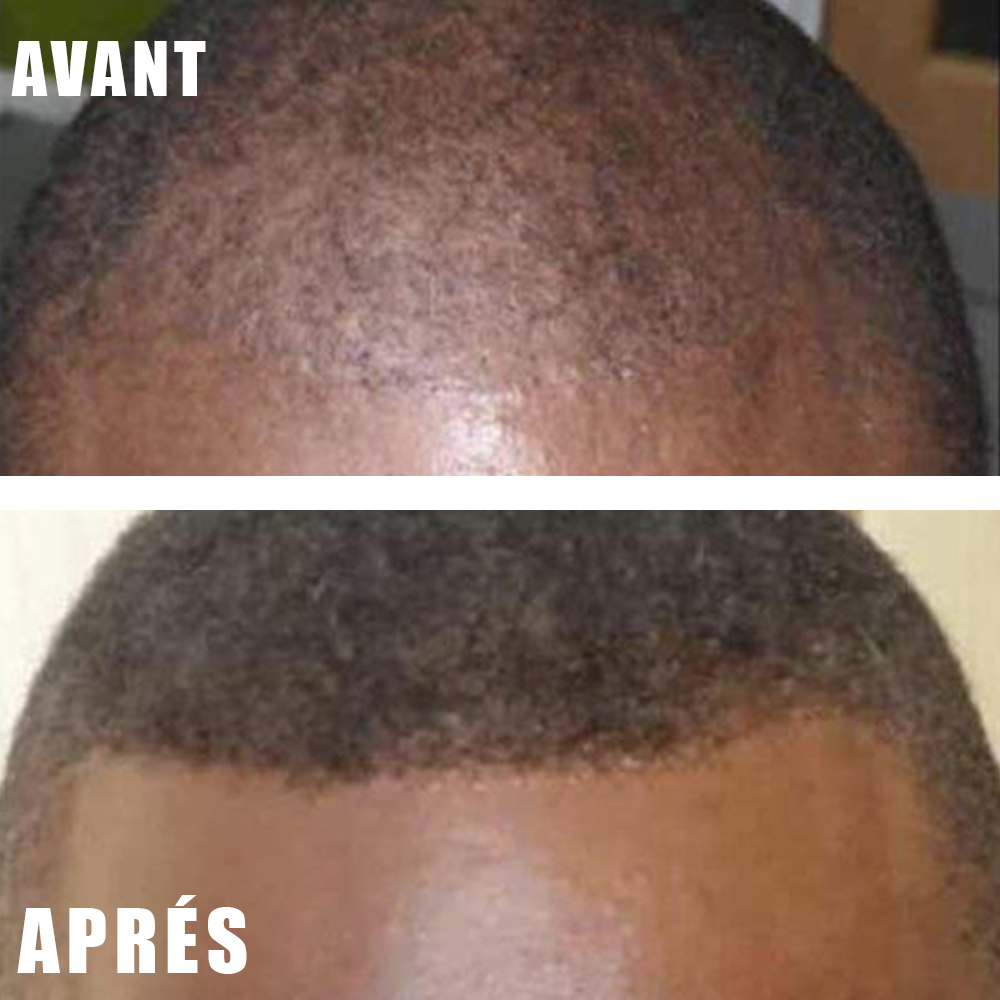 🌿Huile de Croissance Capillaire - Anti-Calvitie .