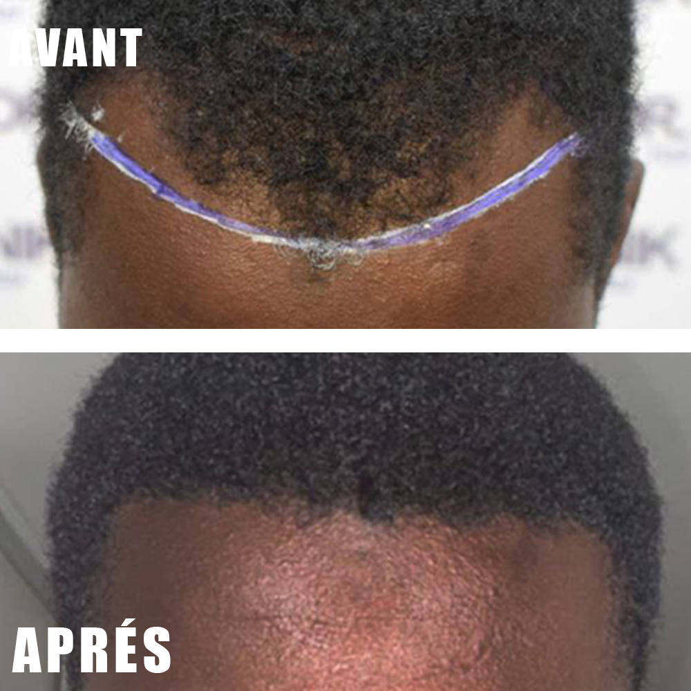 🌿Huile de Croissance Capillaire - Anti-Calvitie .