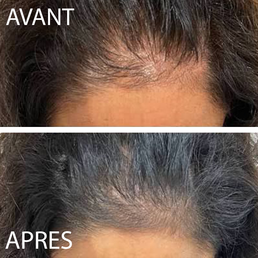 🌿Huile de Croissance Capillaire - Anti-Calvitie .