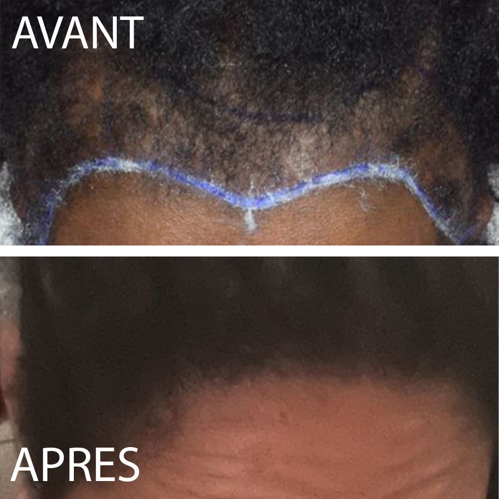 🌿Huile de Croissance Capillaire - Anti-Calvitie ..